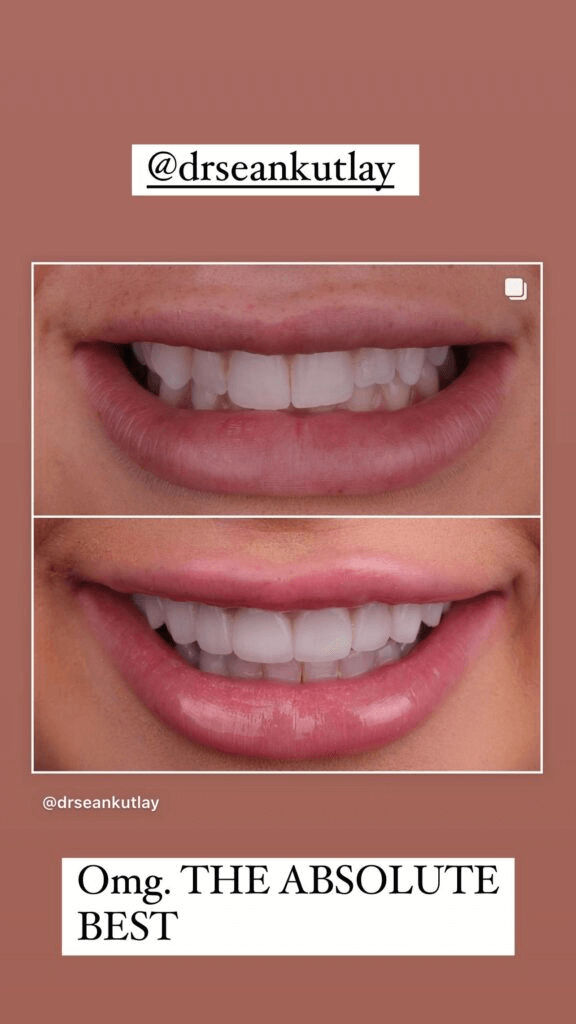 Despite her perfect smile, Emily can thank Veneers for making her look so great. The model shared before and after photos of her teeth last year.